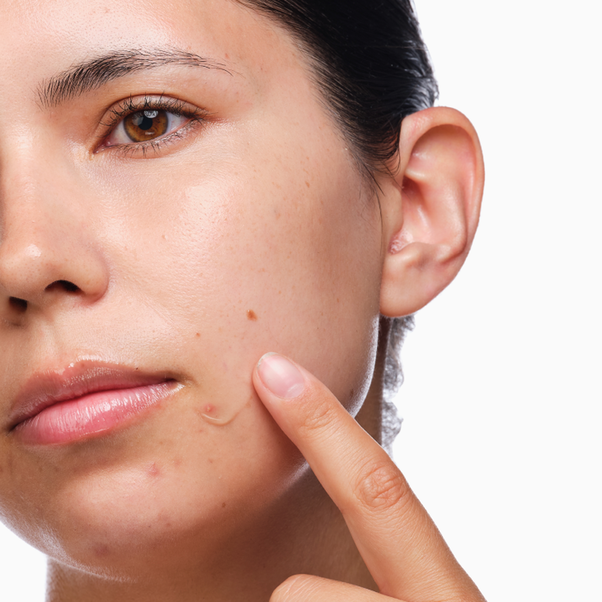 the-acne-set-v8 rdn-the-acne-set-application.png