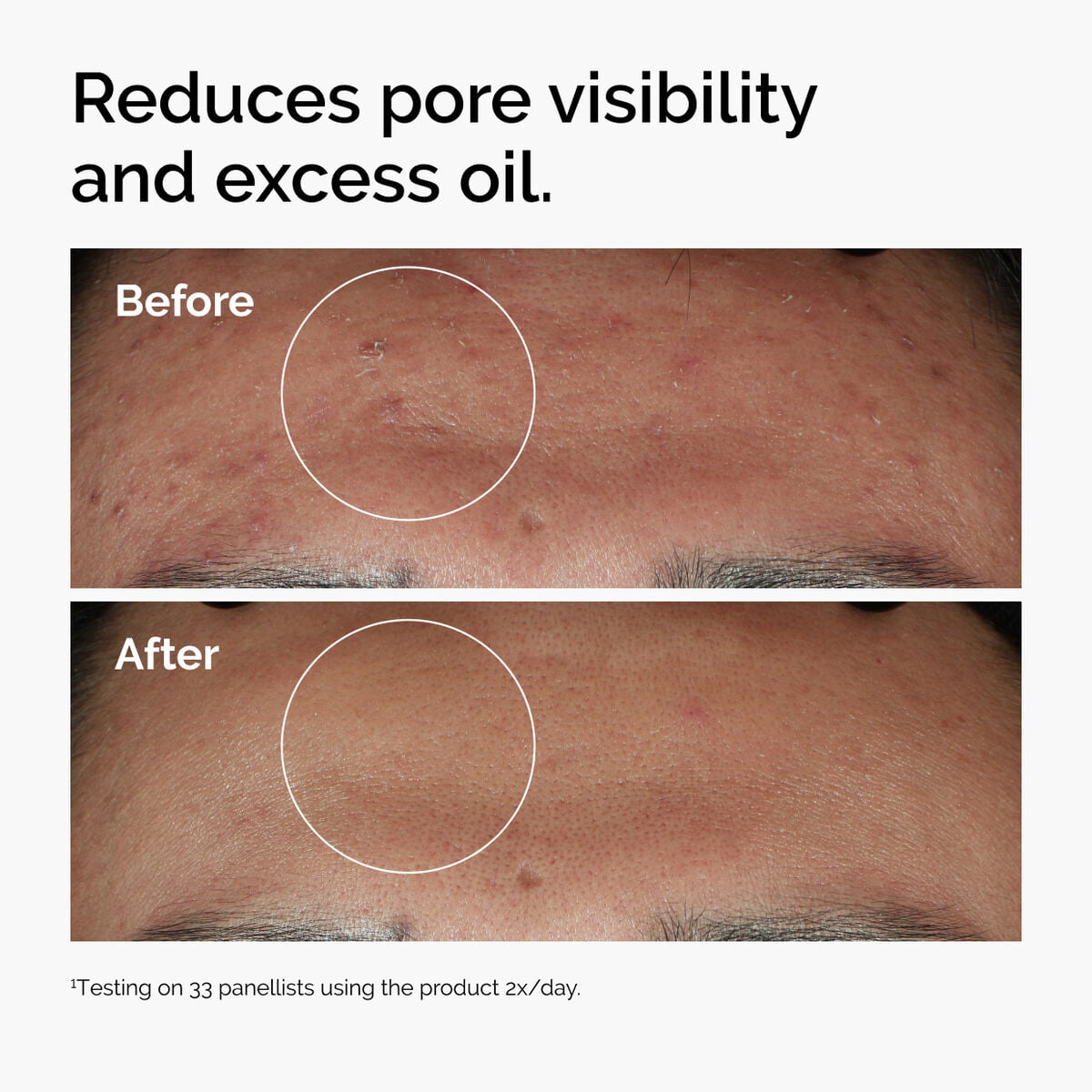 niacinamide-10-zinc-1-r3 ord-niacinamide-zinc-blemish-serum-before-after-pores.jpg