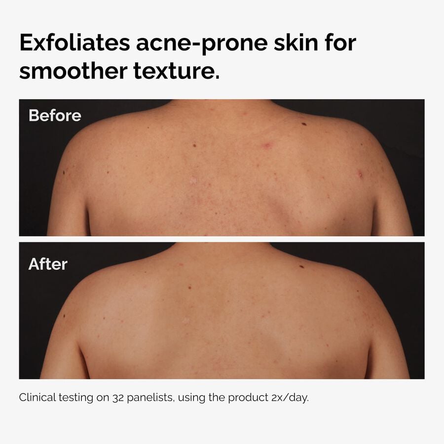 the-body-care-collection-j6 ord-salicylic-acid-body-serum-before-after-graphic-NA.jpg
