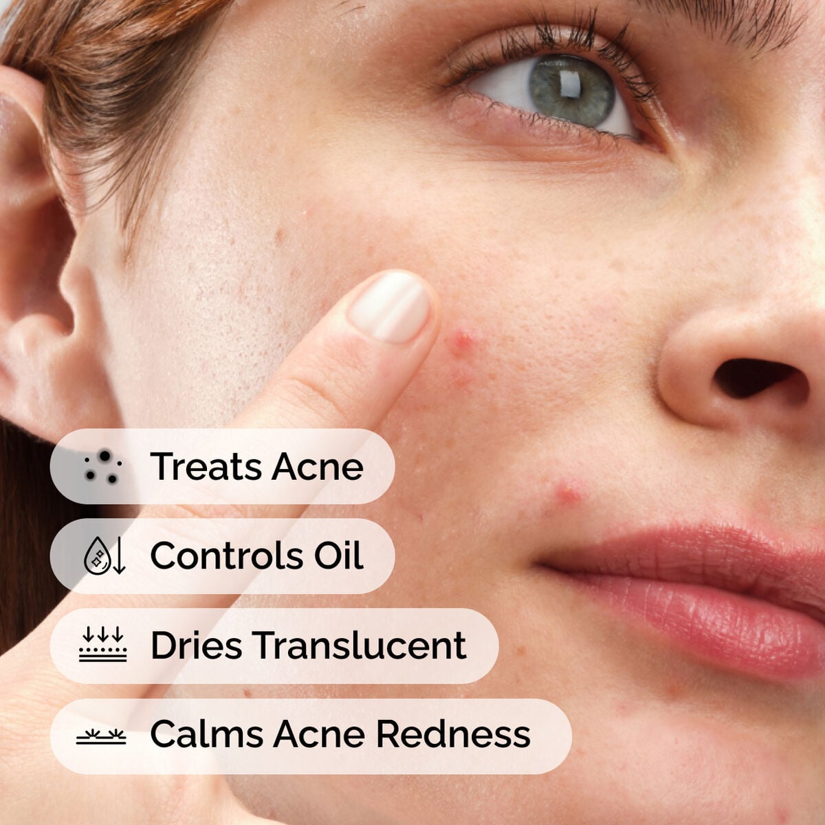 sulfur-10-powder-to-cream-concentrate-u0 ord-sulfur-10pct-powder-to-cream-concentrate-model-application-with-benefits-acne.jpg